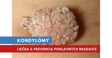 Genitálne bradavice na koži