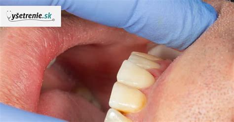 Ilustrácia zubného povlaku a zubného kameňa