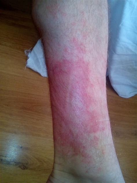 Charakteristické začervenanie a opuch kože pri erysipeli na nohe
