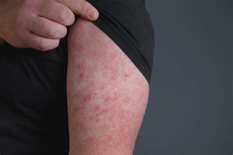 Schéma: Erysipel - infekcia kože a lymfatických uzlín