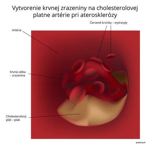 Schematické znázornenie vzniku krvnej zrazeniny a jej možných následkov