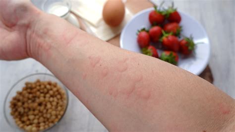alergická reakcia na prvosienku