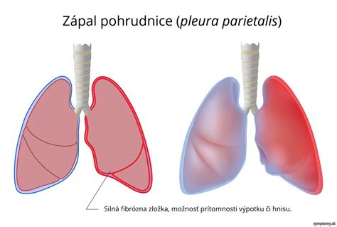 Riziká zanechania triesky v koži: Infekcia a zápal