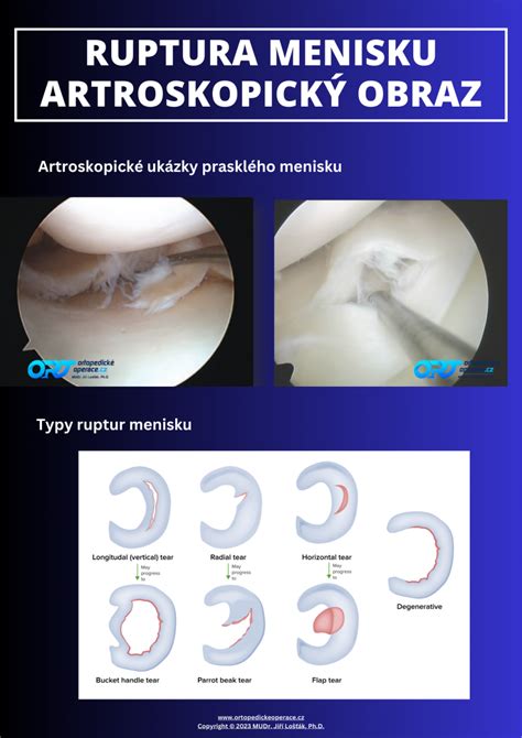 Artroskopická implantácia kolagénu