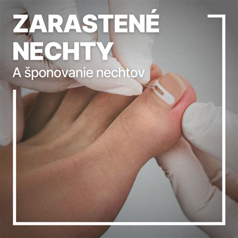 Infografika s tipmi na prevenciu zarastených nechtov