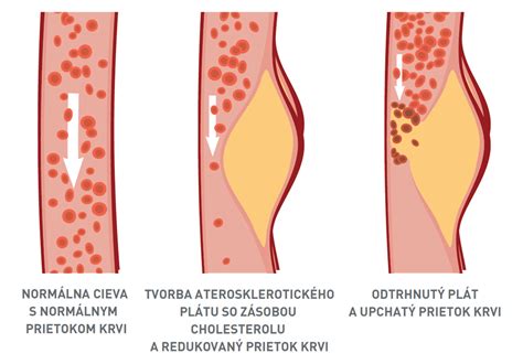 Schéma hladiny cholesterolu a ciev