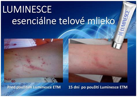 Ilustrácia procesu liečenia limbického odtlačku