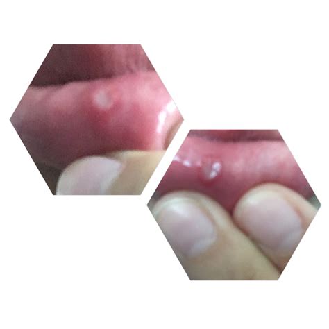 Ilustrácia vzniku afty v ústach